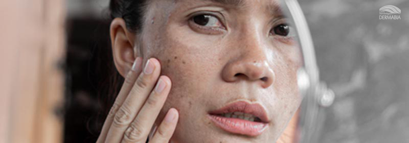 MELASMA