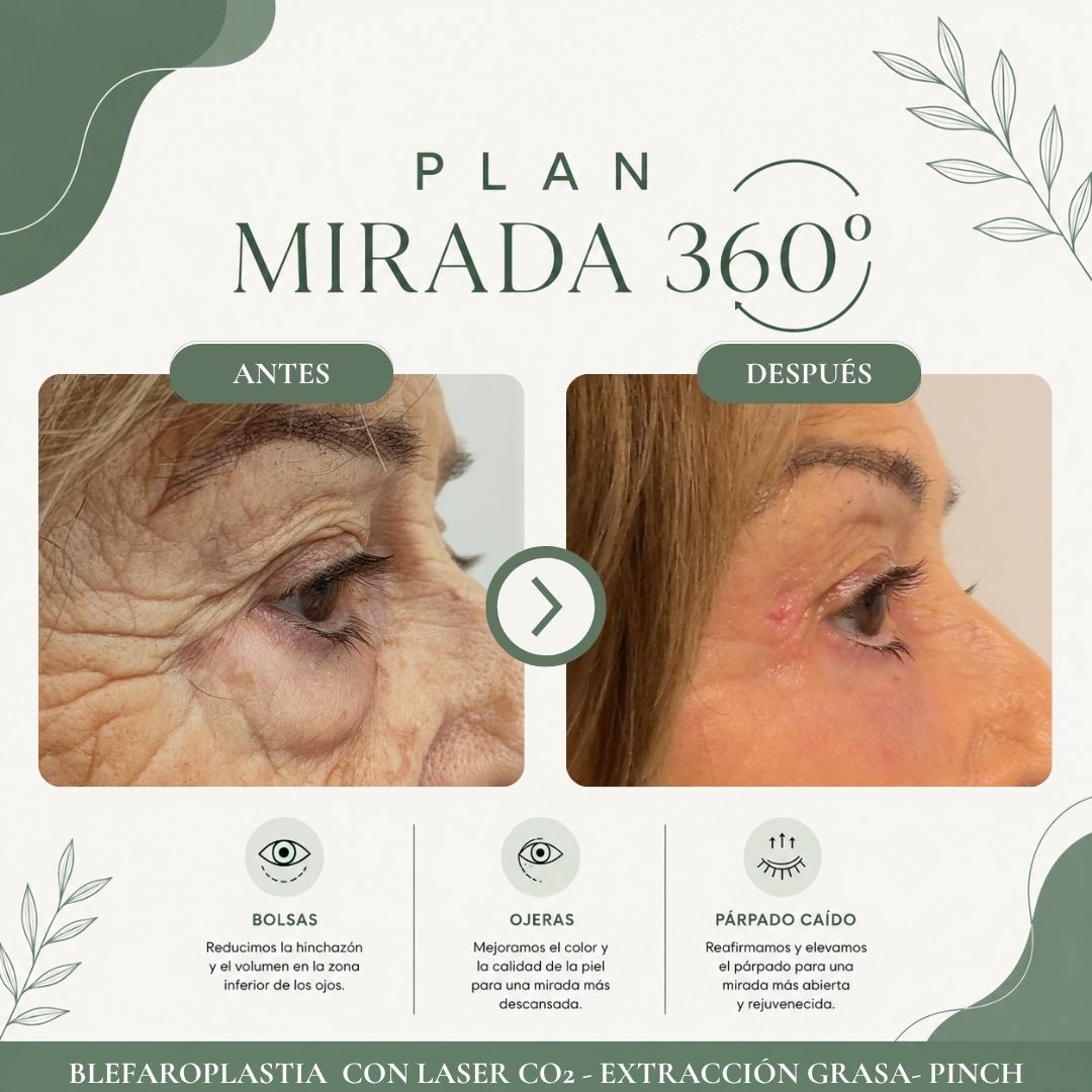 Resultado antes y después del programa Mirada 360 Pro - caso 1