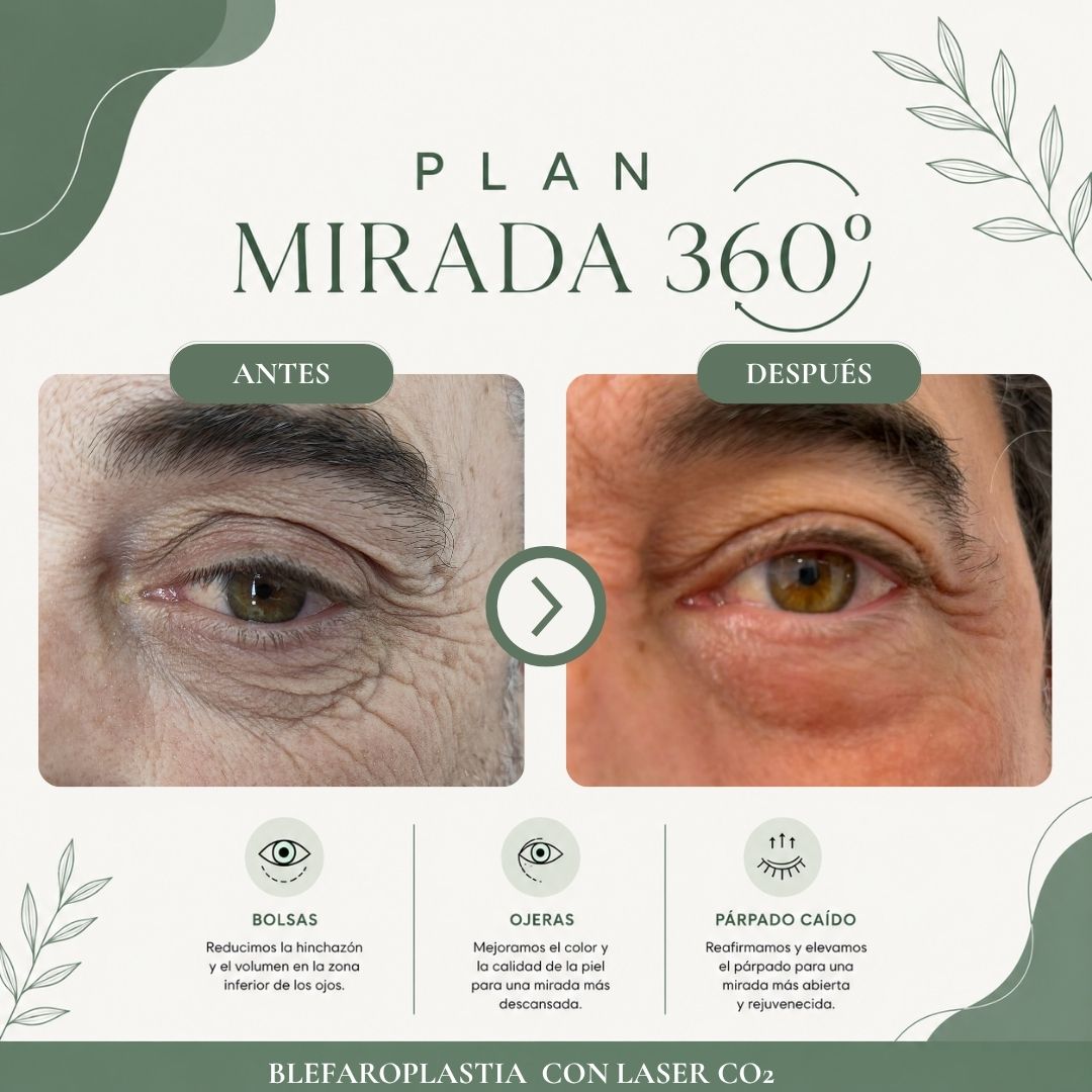 Resultado antes y después del programa Mirada 360 Pro - caso 2