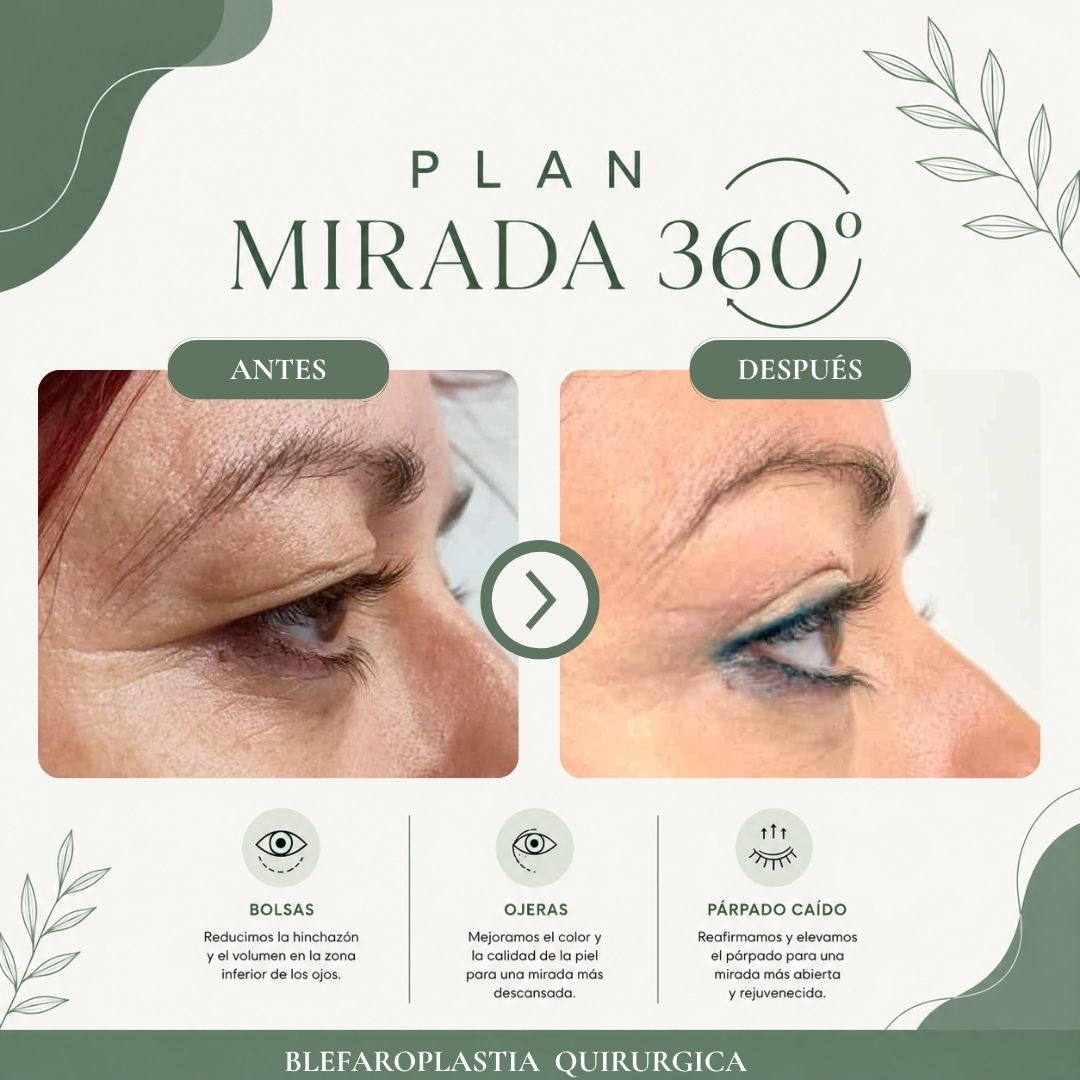 Resultado antes y después del programa Mirada 360 Pro - caso 3