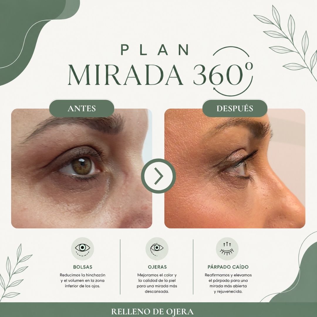Resultado antes y después del programa Mirada 360 Pro - caso 4